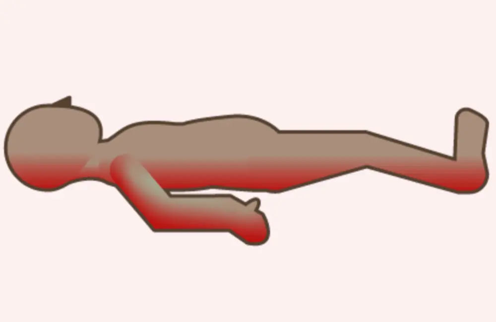 死斑